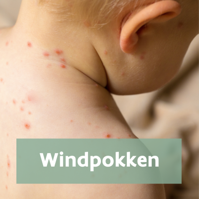 baby met windpokken